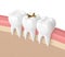 3d render of teeth with dental golden inlay filling