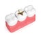 3d render of teeth with dental golden inlay filling