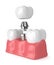 3d render of teeth with dental implant