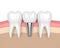 3d render of teeth with dental implant in gums