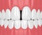 3d render of teeth with diastema