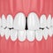 3d render of teeth with diastema