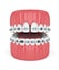 3d render of teeth with diastema and braces