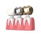 3d render of teeth with different types of dental crown