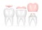 3d render of teeth with different types of dental filling