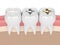 3d render of teeth with different types of dental filling