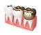 3d render of teeth with different types of dental gold filling