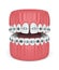 3d render of teeth with divergent diastema and braces