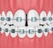 3d render of teeth with divergent diastema and braces