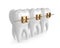 3d render of teeth with golden orthodontic braces