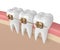 3d render of teeth with golden orthodontic braces