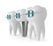 3d render of teeth with implant and braces