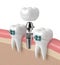 3d render of teeth with implant and braces