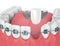 3d render of teeth with orthodontic braces and dental maryland b