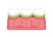 3d render of teeth with plaque and tartar