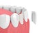 3d render of teeth with veneer