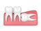 3d render of teeth with wisdom horizontal impaction