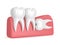 3d render of teeth with wisdom horizontal impaction