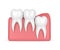 3d render of teeth with wisdom vertical impaction