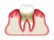 3d render of tooth in bleeding gums