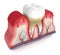 3d render of tooth in bleeding gums