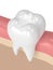 3d render of tooth with dental composite filling