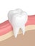 3d render of tooth with dental composite filling