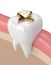 3d render of tooth with dental golden inlay filling