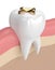 3d render of tooth with dental golden inlay filling