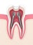 3d render of tooth with dental root canal posts