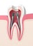 3d render of tooth with dental root canal posts