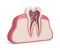 3d render of tooth with dental root canal posts