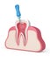 3d render of tooth with endodontic file in gums