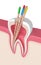 3d render of tooth in gums with gutta percha