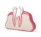3d render of tooth with stainless steel dental post and filling