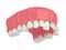 3d render of upper jaw with abnormal teeth position