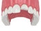 3d render of upper jaw with broken incisor tooth