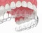 3d render of upper jaw with invisalign removable retainer