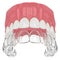 3d render of upper jaw with invisalign removable retainer