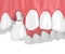 3d render of upper jaw with teeth and dental premolar crown