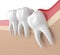 3d render of wisdom mesial impaction with pericoronitis