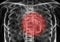 3D rendering illustration coronavirus x-rays  lung show terrifying damage in lungs of Covid-19 analyze first US patient with coro
