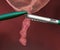 3D rendering of metal tool and closeup of Appendicitis - painful swelling of the appendix