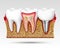 3d teeth in a cut with nerve endings.