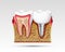 3d teeth in a cut with nerve endings.