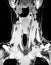 4d ct scan of parathyroid adenoma modern exam