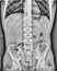 Abdomen medical xray, lungs, heart, rig cage, pelvic bone, spinal cord and internal organs