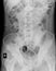Abdomen showing DJ stent in right ureter.medical image