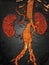 Abdominal aneurysm illustration, CT