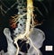 Abdominal aorta aneurysm rc iliac artery aneurysm